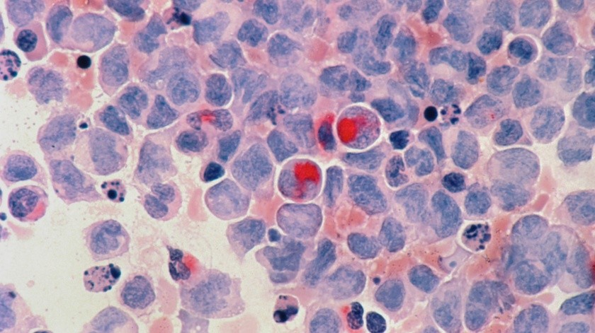 La leucemia se origina de células que se convertirían en glóbulos blancos.