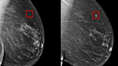La inteligencia artificial podría detectar cáncer de mama hasta 5 años antes de que se desarrolle