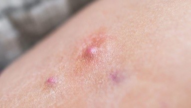 No se debe confundir la hidradenitis supurativa con el acné: Esto es lo que dice un experto