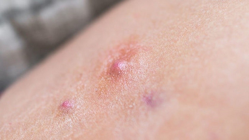La hidradenitis puede verse muy abultada además de picar en la piel.(Cleveland Clinic)