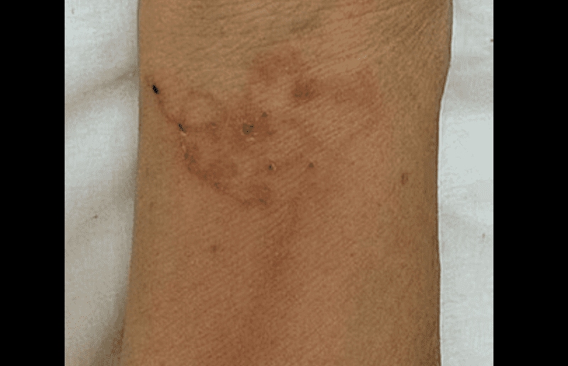 La imagen muestra a los parásitos excavando debajo de la piel de la paciente. FOTO: NEWFLASH