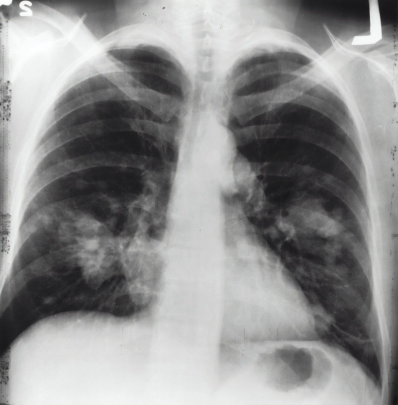 Según especialistas este tipo de infección ingresa al cuerpo mediante los pulmones y es posible que se propague a otras prtes del cuerpo. Institute National Cáncer/UNSPLASH