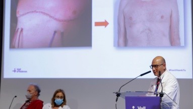 Primer trasplante pulmonar robótico sin abrir el tórax lo realizan en hospital español