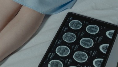 Esclerosis múltiple: Encuentran un fármaco que puede retrasar los primeros síntomas