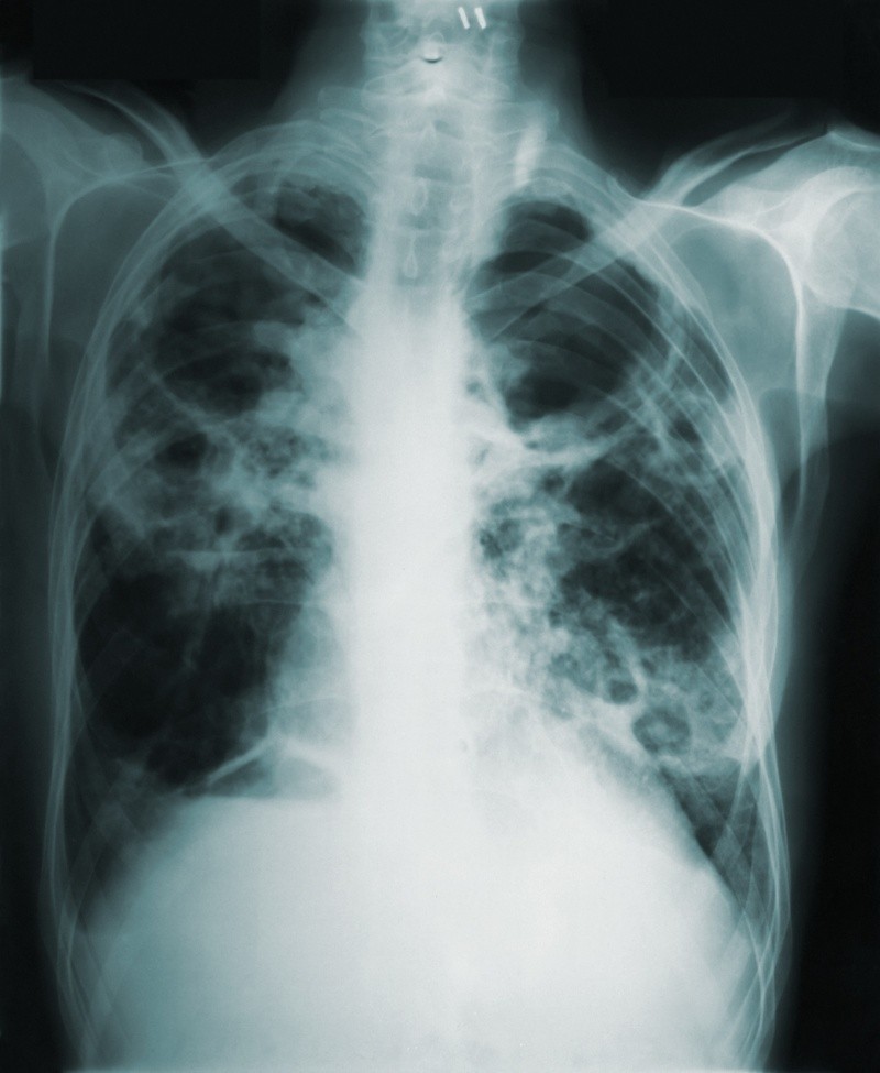En ocasiones el cáncer de pulmón puede haberse diseminado a otras partes del cuerpo (metástasis) y causar síntomas específicos en la parte afectada. FOTO: CDC/PEXELS