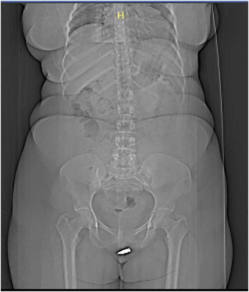 Una tomografía computarizada mostró que la mujer tenía una bala en el clítoris. Foto: International Journal of Surgery Case Reports,