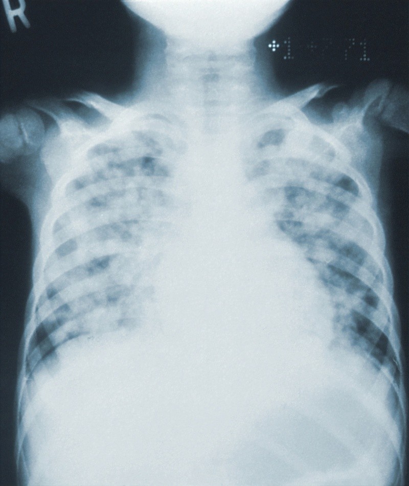 Los sacos aéreos se pueden llenar de líquido o pus (material purulento), lo que provoca tos con flema o pus, fiebre, escalofríos y dificultad para respirar  FOTO:CDC/UNSPLASH