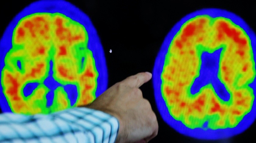 El fármaco de Lilly ralentizó el deterioro cognitivo del Alzheimer temprano, según indicó un estudio.(Reuters)