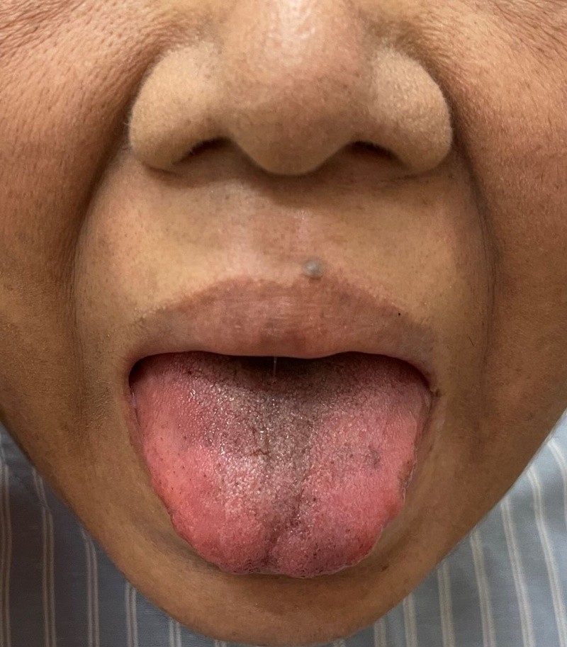 El reporte indica que la pigmentación facial y las lesiones de la lengua mejoraron después de seis semanas. FOTO: British Medical Journal Case Reports