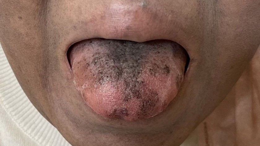 La lengua vellosa negra es una enfermedad bucal, inofensiva y temporal la cual puede aparecer por diversos factores.(British Medical Journal Case Reports)