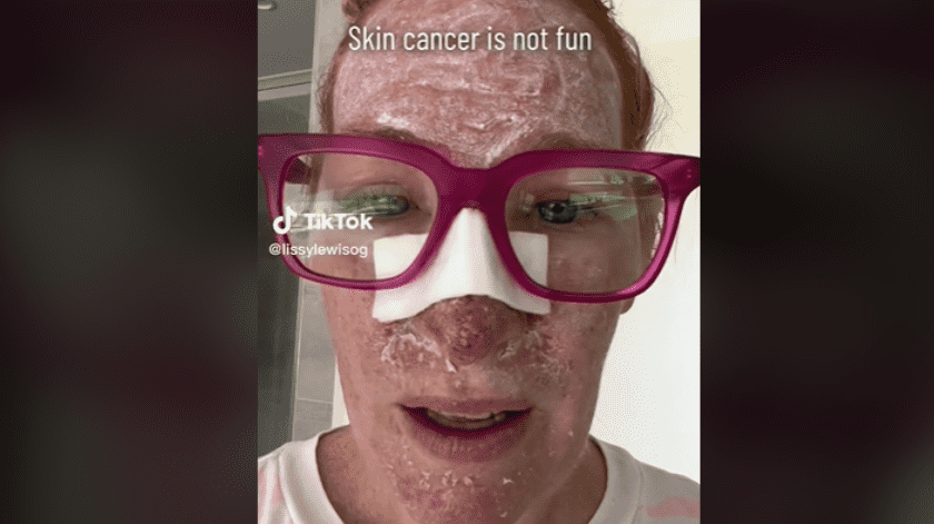 Una mujer australiana compartió en TikTok su experiencia con el cáncer de piel.(Foto: Captura TikTok)
