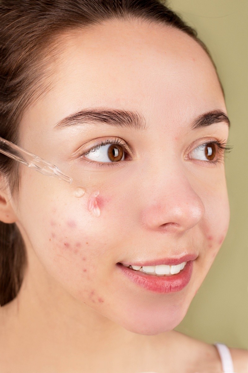  El acné a veces puede ser causado por bacterias. Anna Nekrashevich en Pexels.  