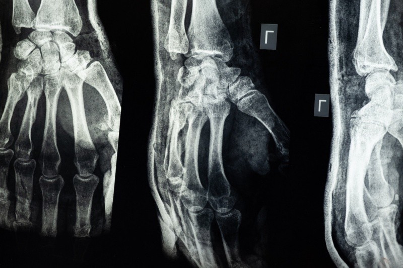 Los huesos deben revisarse por medio de la densitometría ósea. Foto de cottonbro studio en Pexels.  