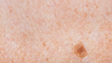 Día Mundial contra el Melanoma: ¿Cuáles son los síntomas de este agresivo cáncer de piel?