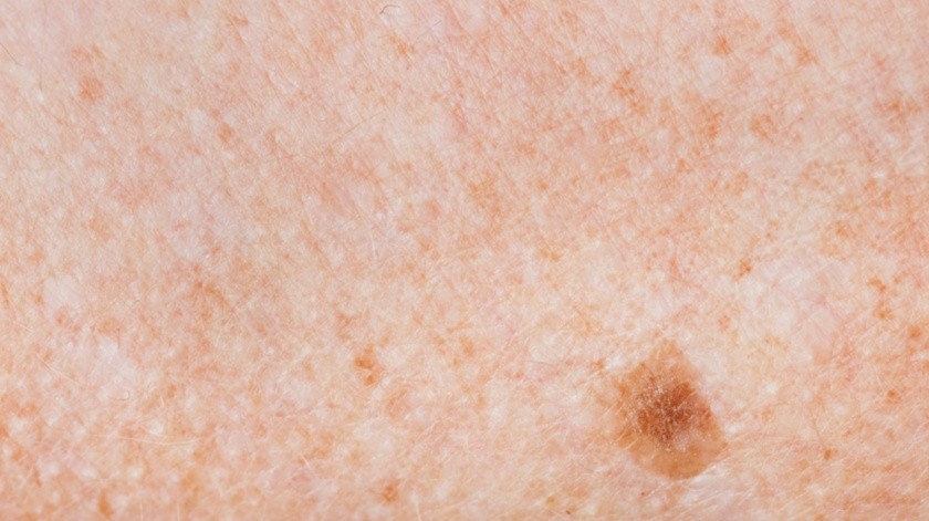 El melanoma es considerado el cáncer de piel más peligroso.(Foto de rawpixel.com en Freepik)