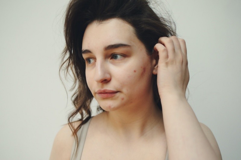 El acné en la barbilla puede ser causado por diversos factores, como desequilibrios hormonales FOTO:Polina Tankilevitch/PEXELS