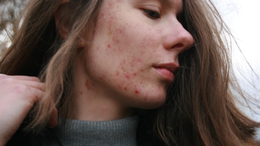 El cuidado adecuado de la piel y una buena higiene pueden ayudar a prevenir y controlar el acné en la barbilla(Barbara Krysztofiak/UNSPLASH)