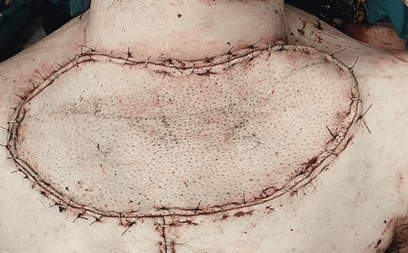 Los médicos utilizaron piel y tejido graso de otras partes del cuerpo para cubrir las heridas abiertas.  