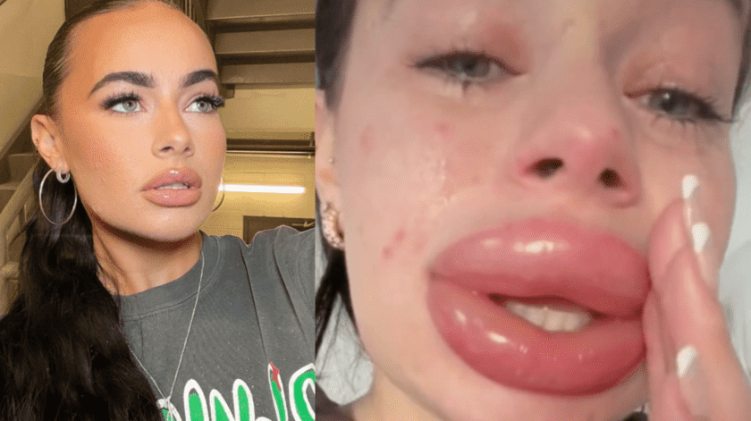 Un relleno de labios mal realizado dejó a una mujer con una cara irreconocible(TinTok/Instagram)