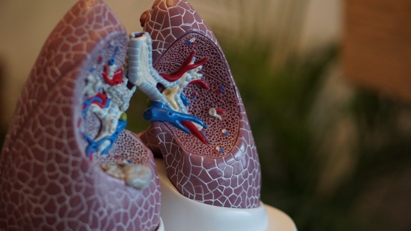 El cáncer de pulmón es un cáncer que se forma en los tejidos del pulmón, generalmente en las células que recubren los conductos de aire