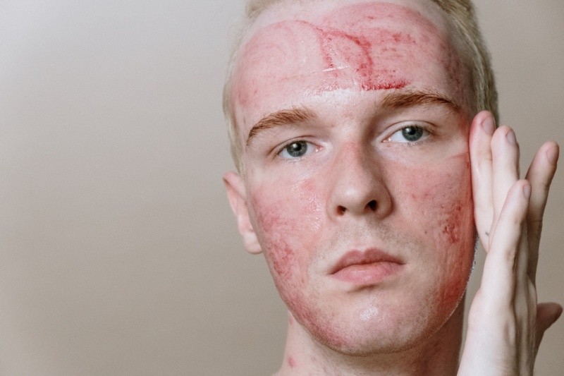 El acné puede inflamar mucho la piel. Foto de cottonbro studio en Pexels. 