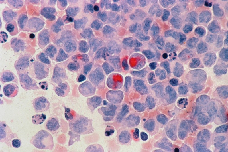 Las células se multiplican rápidamente y pueden invadir y destruir tejidos sanos del cuerpo. FOTO: National Cancer Institute