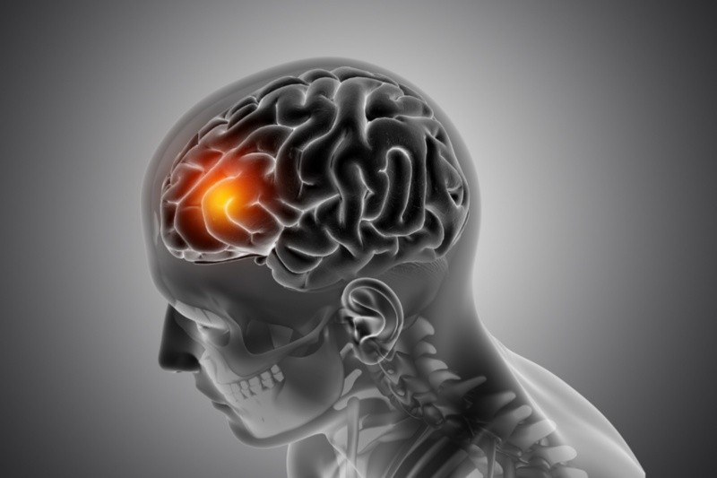 Un derrame cerebral puede dejar graves daños si no se recibe atención médica a tiempo. Imagen por kjpargeter en Freepik
