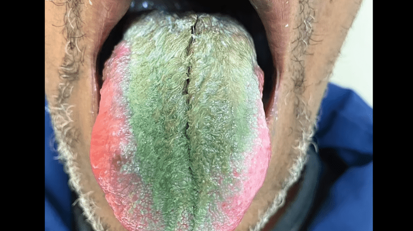 La lengua de un hombre de Ohio se torna verde y peluda debido a una inusual combinación de tabaquismo y antibióticos(New England Journal of Medicine)