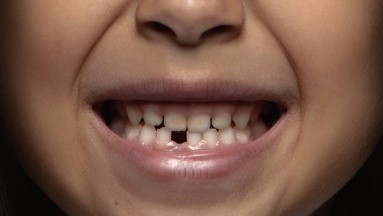 A un niño de 7 años le extrajeron 526 dientes por un tumor asociado al desarrollo dental