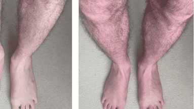 Covid prolongado y las piernas que cambian de color al ponerse de pie