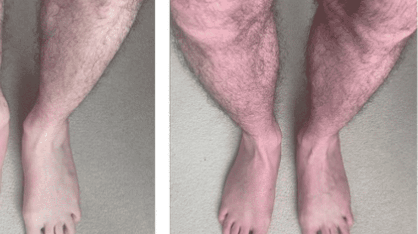 Las piernas cambiantes de color como un síntoma de covid prolongado y disautonomía.(The Lancet/Manoj Sivan)