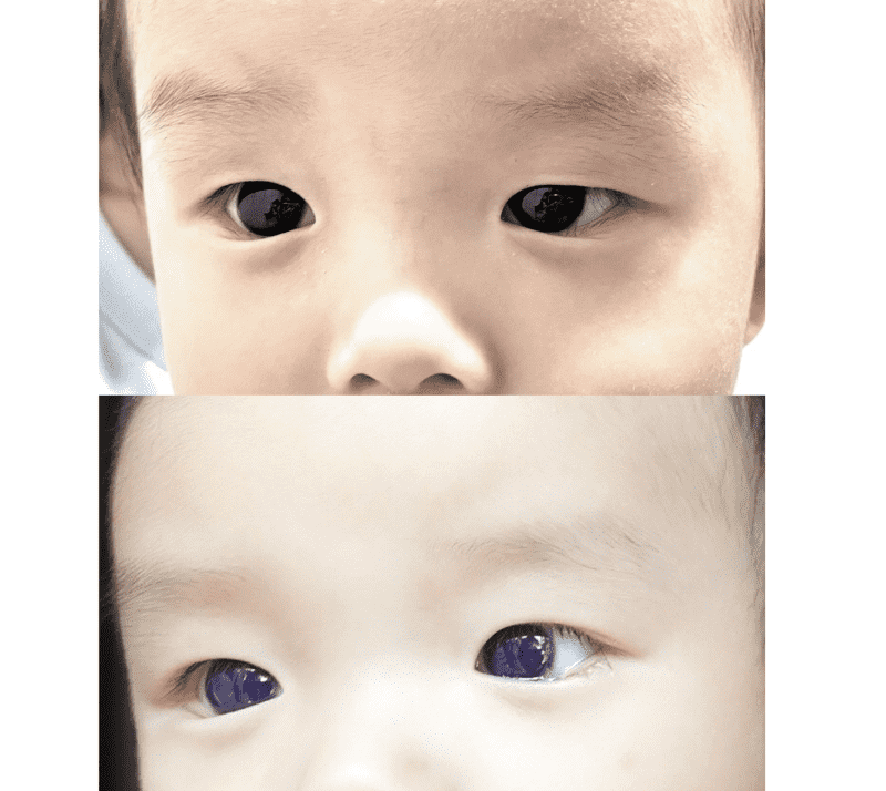 El favipiravir y el inesperado cambio en el color de los ojos de un bebé. FOTO: Frontiers in Pediatrics