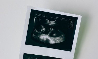 ¿Cómo aumentar las posibilidades de embarazo si tienes síndrome de ovario poliquístico?