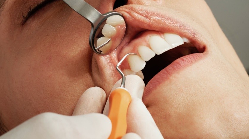 El sarro es un problema común en la salud dental y puede contribuir a enfermedades(Caroline LM/UNSPLASH)