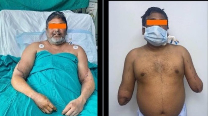 El paciente, Raj Kumar, había perdido sus brazos en un trágico accidente en 2020.(Twitter)