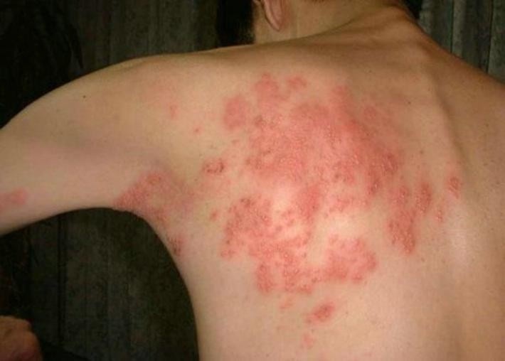 Una enfermedad inflamatoria crónica de la piel,  causa irritación y lesiones escamosas.