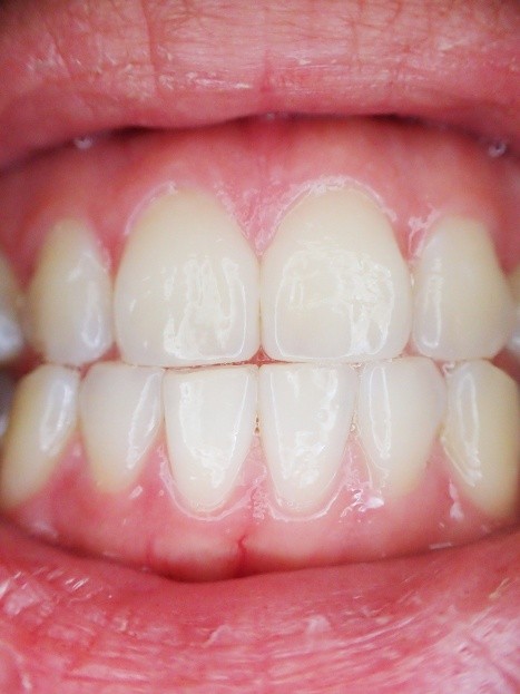 Cuando los almidones y azúcares de los alimentos y bebidas interactúan con estas bacterias, en los dientes se forma una película pegajosa conocida como placa. 