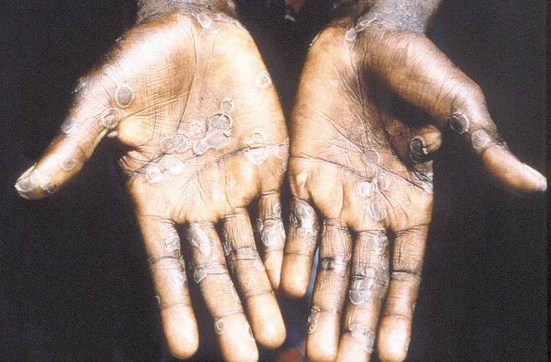 magen de las lesiones en la piel provocadas por la viruela del mono, durante un estudio llevado a cabo en la República Democrática del Congo entre los años 1996 y 1997.