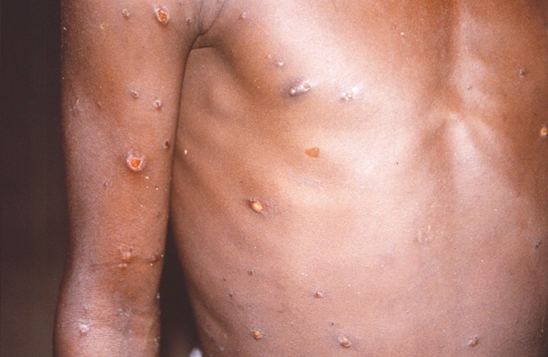 En la imagen se muestra a una persona con un caso activo de viruela s�mica.