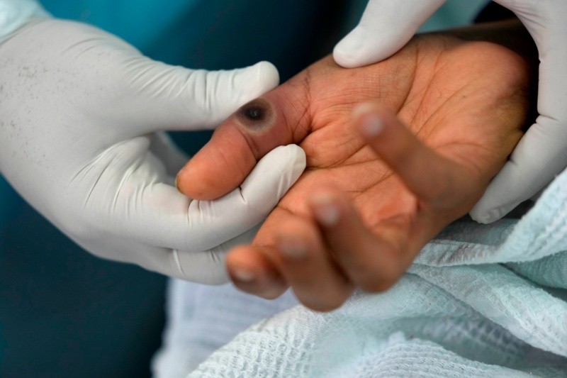 Un medico muestra una llaga en la mano de un paciente causada por la viruela símica en el hospital Arzobispo Loayza en Lima, Perú, el martes 16 de agosto de 2022. (Foto AP/Martín Mejía)