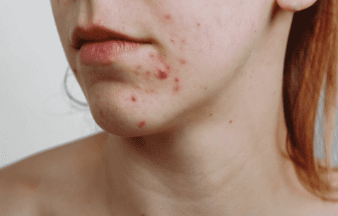 El acné debe ser tratado por un especialista. Archivo GH.  