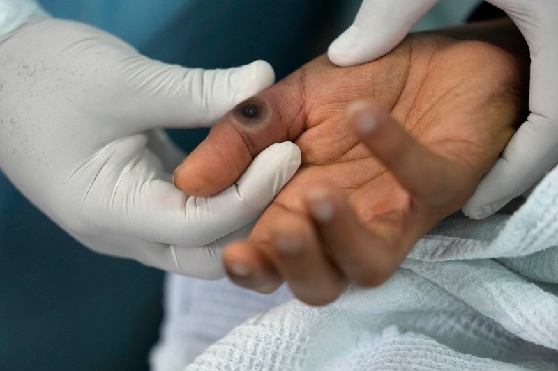 Un medico muestra una llaga en la mano de un paciente causada por la viruela símica en el hospital Arzobispo Loayza en Lima, Perú, el martes 16 de agosto de 2022. (Foto AP/Martín Mejía)