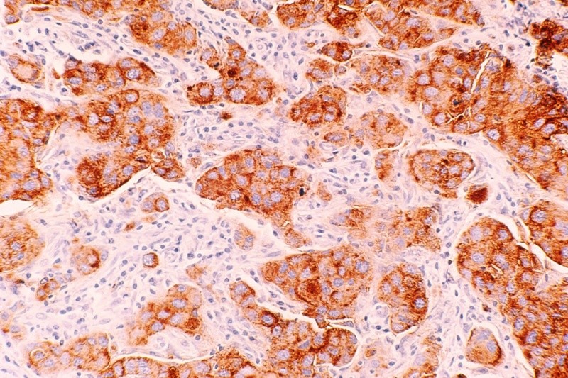 Este cáncer proviene de las células inmunitarias llamadas linfocitos B