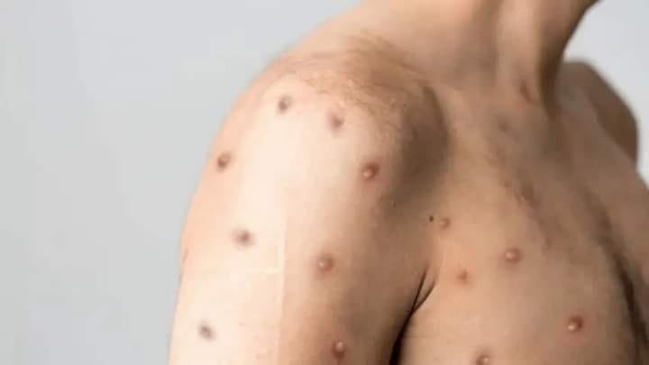 La viruela del mono puede presentar lesiones en la piel como ronchas. Archivo GH. 