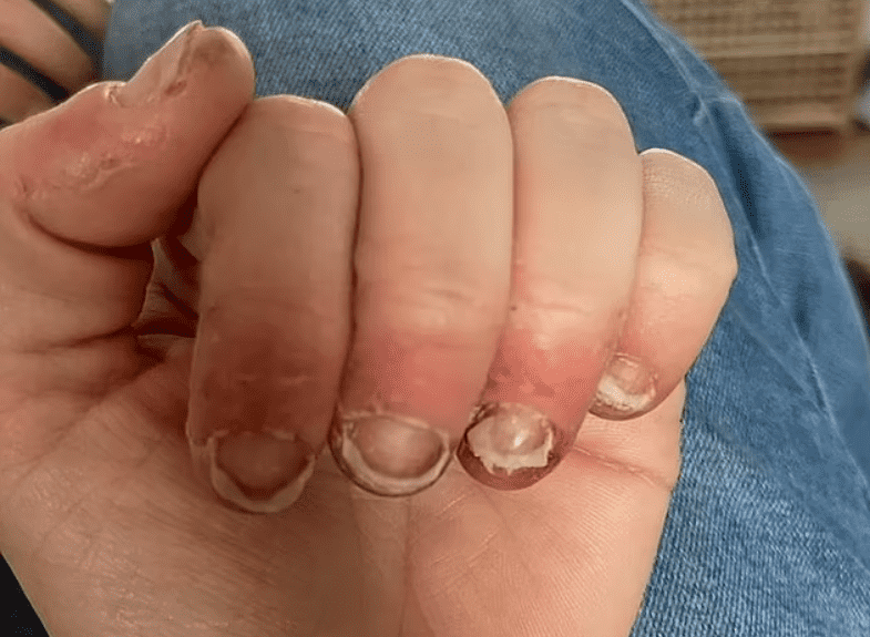Así es como le han quedado las uñas a Dewey después de sufrir una supuesta reacción alérgica. FOTO: Lisa Dewey