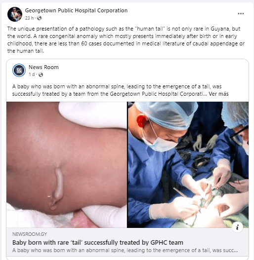 Los especialistas extirparon la cola humana de un bebé. Foto: Captura Facebook 