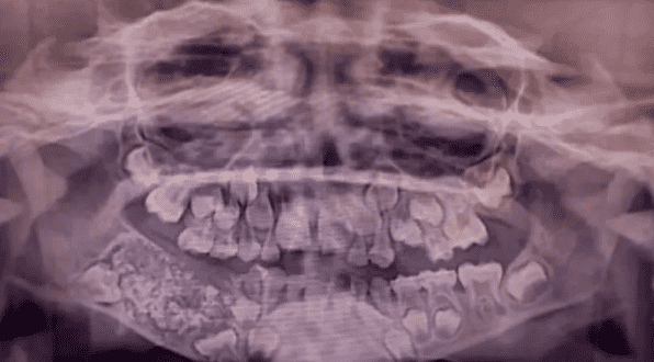 Un niño de la India fue diagnosticado con un tumor en la mandíbula. Imagen por el Instituto de Ciencias Médicas y Técnicas de Saavetha 