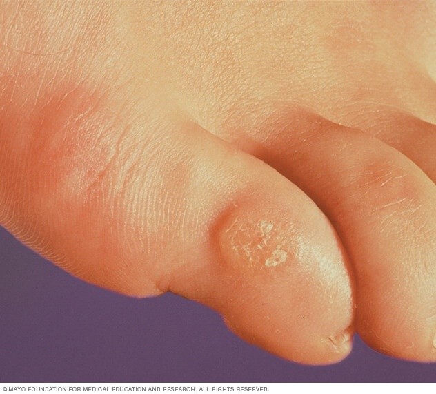 Los callos pueden aparecer en los dedos de los pies y hasta en la planta del pie. Foto: Mayo Clinic.  