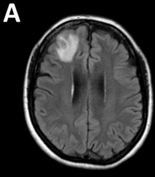 Las exploraciones revelaron una lesión en el cerebro de la mujer y luego de entrar a quirofano encontraron el parásito. FOTO: CDC.gov