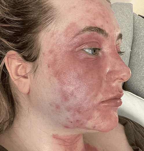 Su reacción alergica le provocó una piel dolorosa y escamosa en su rostro y cuerpo. foto:dailymail